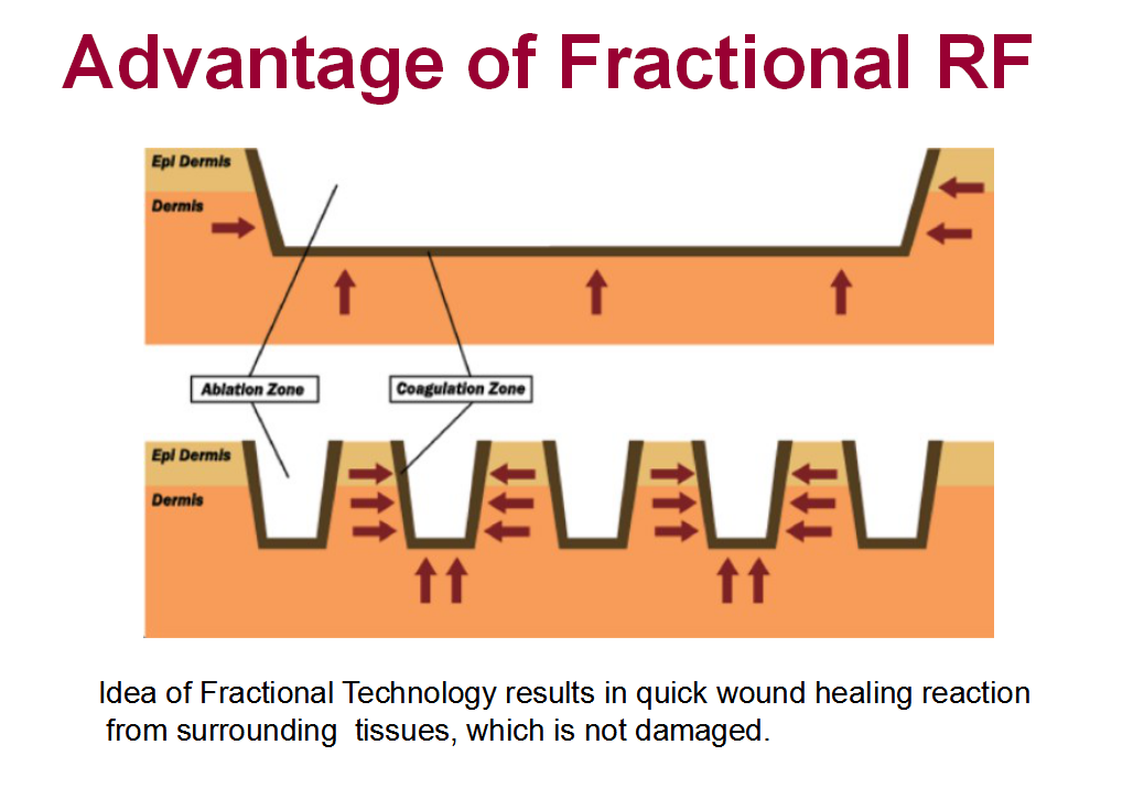 Rf Fractional Needle Fractional Radiofrequency Micro Needling Rf Lifting Pinxel-2